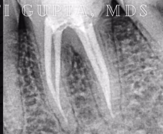 Painless Single Visit Root Canal Therapy (RCT)