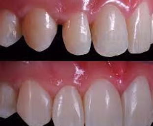 Composite Veneer