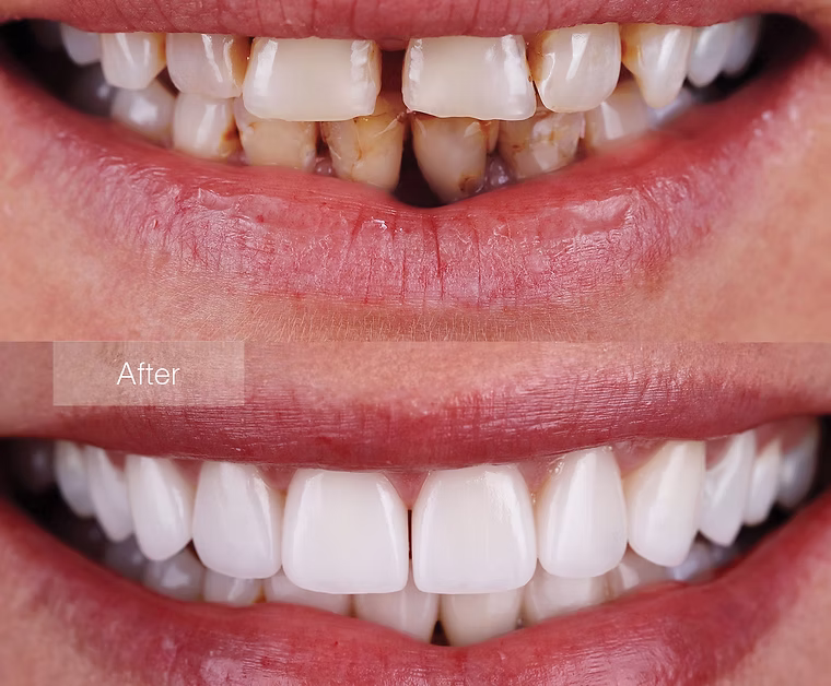 Porcelain Veneer