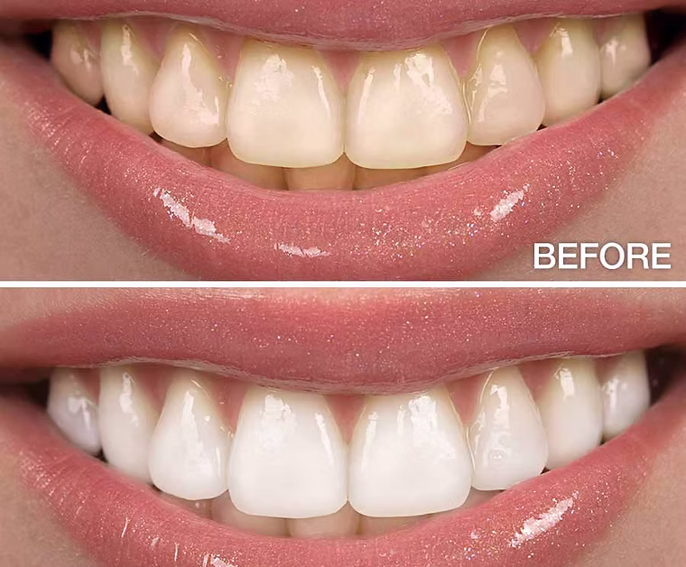 Tooth Whitening (Bleaching)