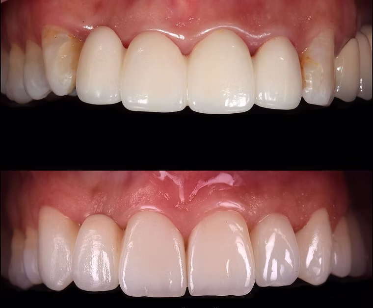 Metal-Free, Zirconia, eMax Crown & Bridge