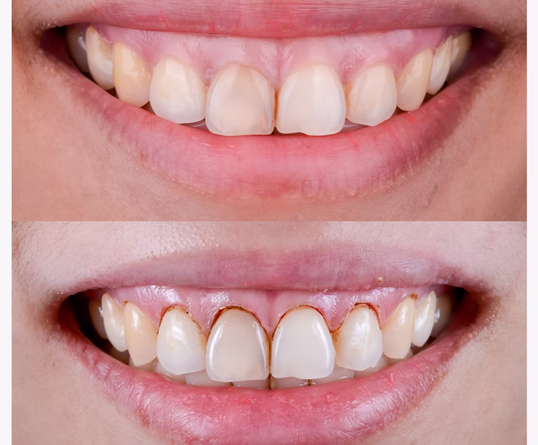 Laser Dentistry