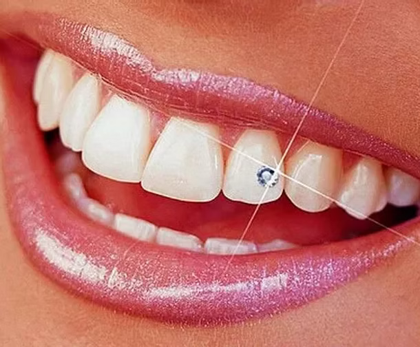 Dental Jewellery