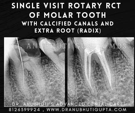 Painless Root Canal & Smile Restoration