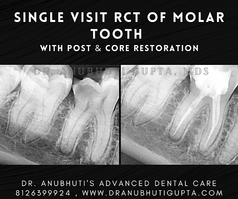 High-Precision Ceramic Restoration